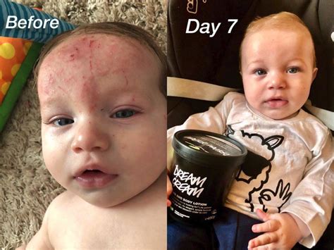 A Mom Claims A Lush Lotion Cleared Her Babys Eczema — And The Amazing