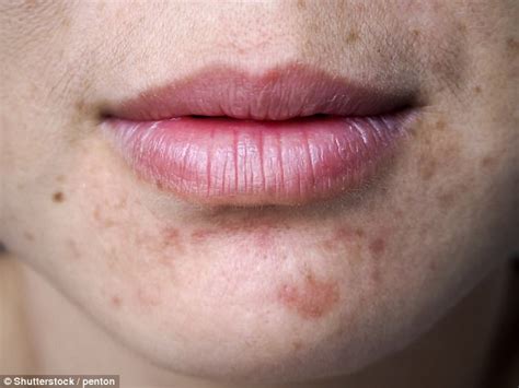 Four Facial Changes That Could Signal A Medical Condition Daily Mail
