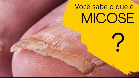 Micose Você Sabe O Que é Youtube