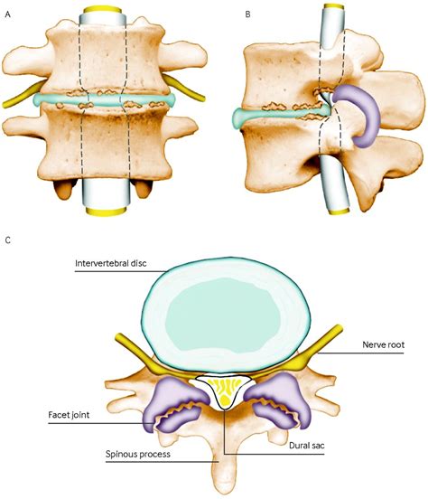 Management Of Lumbar Spinal Stenosis The Bmj