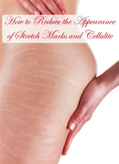 How To Reduce The Appearance Of Stretch Marks And Cellulite Beauty