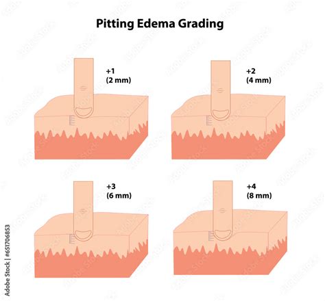 Pitting Edema Grading Illustration With The Grades And Mm