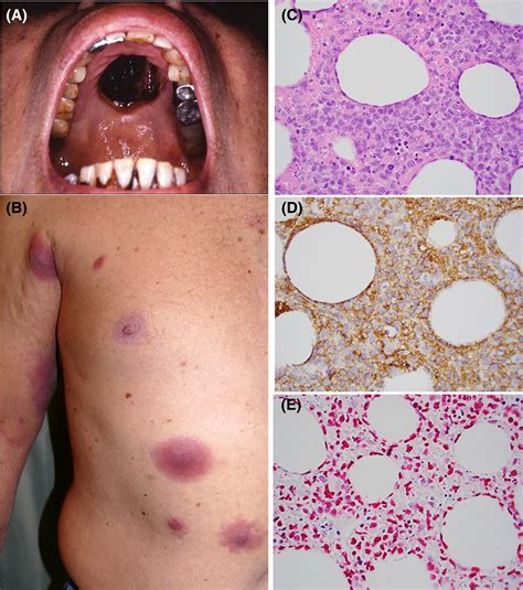 Clinical Manifestations And Pathogenesis Of Cutaneous Lymphomas