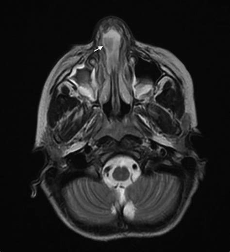 Spontaneous Nasal Septal Abscess Presenting As A Soft Tissue Mass In A