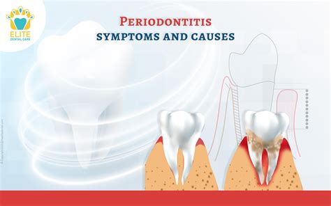 Periodontitis And Its Symptoms Elite Dental Care