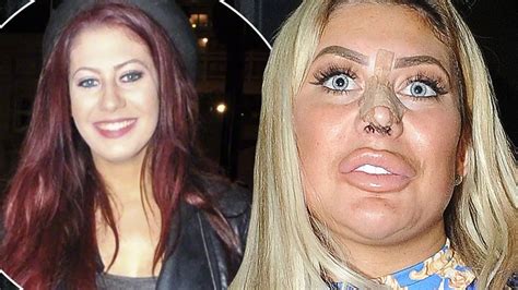 Shocking Before And After Pictures Show Chloe Ferrys Extreme Transformation As Fans Beg Her To