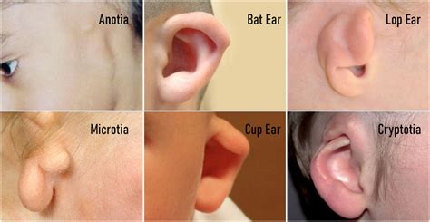 Ear Deformities In Mumbai India Usa England Ear Deformities In