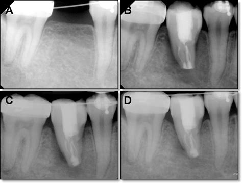 Orthognathic Treatment With Autotransplantation Of A Third Molar