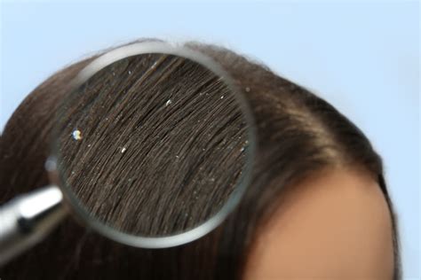 What Are The Different Scalp Types And How To Treat These Scalp Conditions