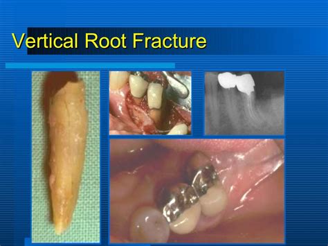 Periodontitis Associated With Endodontic Lesions