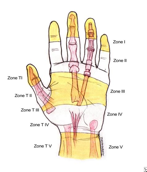 Flexor Tendon Injuries Hand Orthobullets