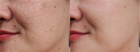 Cómo quitar las manchas en la cara por un dermatólogo experto
