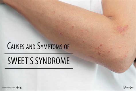 causes and symptoms of sweet s syndrome by dr manju keshari lybrate