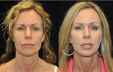 Facial Fat Grafting Before And After Photos Facelift Beverly Hills