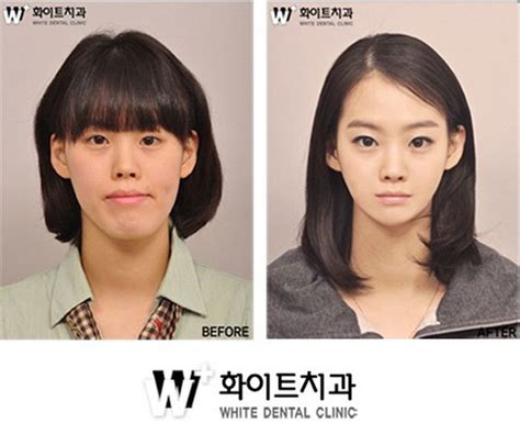 Crazy Before And After Photos Of Korean Plastic Surgery Korean Plastic Surgery South