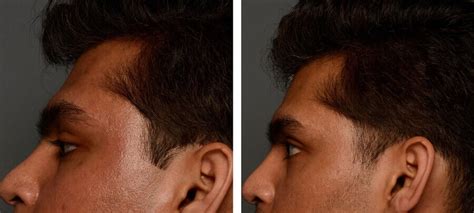 Dermal Fillers Before And After Kingsway Dermatology