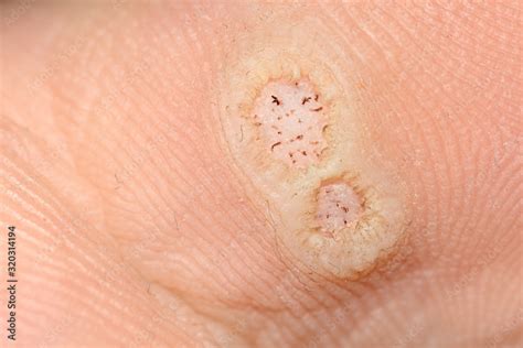 Hpv Fotos Da Doença