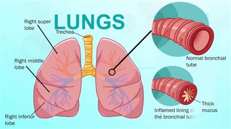 13 Common Bronchitis Symptoms And Signs With Treatment