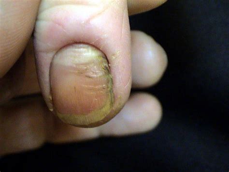 Nail Diseases Onychomycosis Due To Candida Albicans Infection Picture