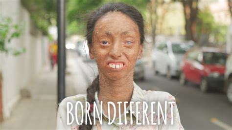 The Girl Whose Skin Peels Off Born Different
