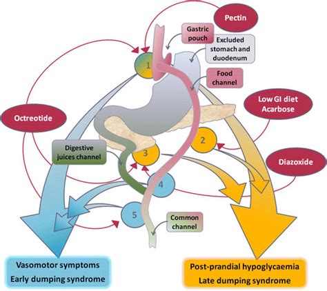 Belirtilen operasyonlar sonrasında özellikle şekerli besilerin. Pathophysiology of dumping syndromes following gastric ...