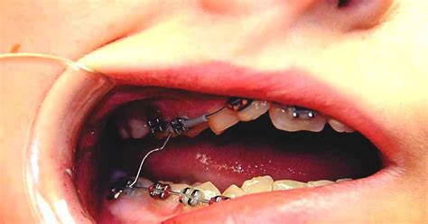 Orthodontics How To Handle Braces Emergencies Wire Poking Sore Teeth