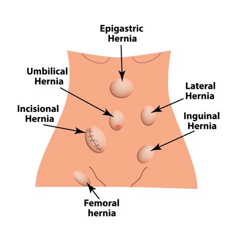 External Abdominal Wall Hernias Abdominal Hernia Abdominal Anatomy My XXX Hot Girl