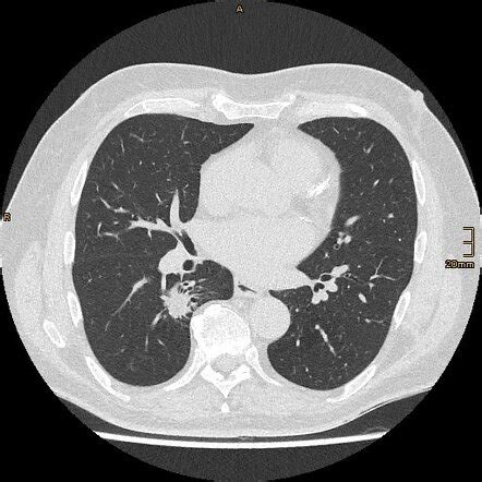 Lipoid Pneumonia Radiology Case Radiopaedia Org