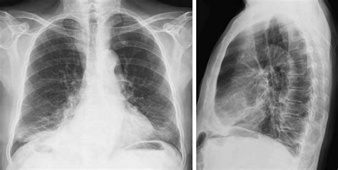 Rayos X del tórax radiografía de tórax Medimagen