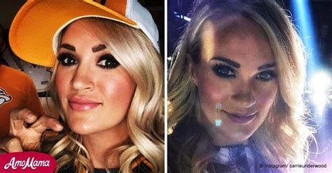 Carrie Underwood Reveals The Facial Scars Above Her Lip In A New Photo