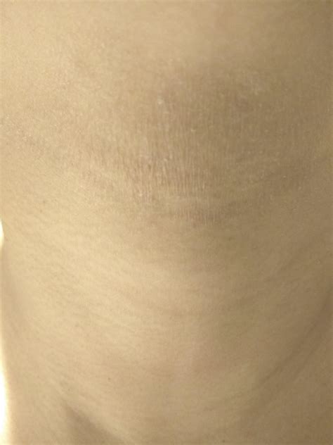 Skin Concern Dry Patches On My Neck And Face Skincareaddiction