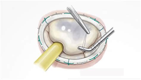 3 Patient Tips To Get Great Mitral Valve Surgery Outcomes Mitral