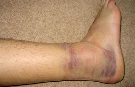 A Sprained Ankle Causes Symptoms Types Grades Treatments