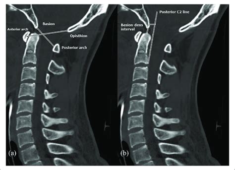 Spect Ct Scan Cervical Spine Ct Scan Machine Images And Photos Finder
