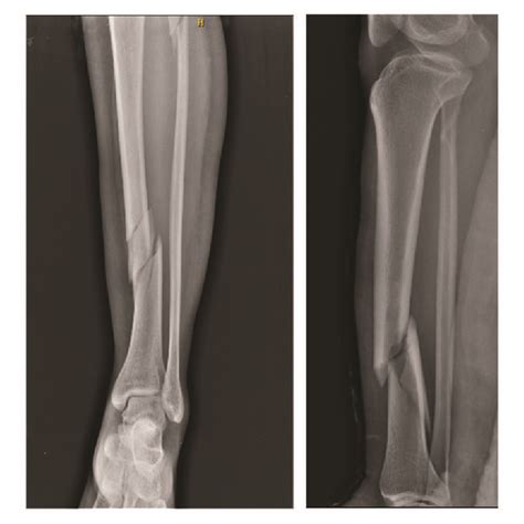 Radiographs Showing The Anteroposterior And Lateral Views Of Tibial