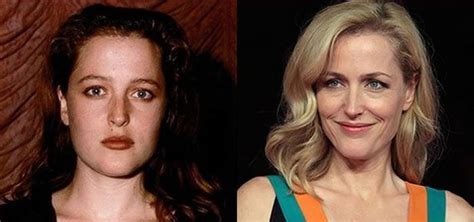 The Right Kind Of Changes From Gillian Andersons Plastic Surgery Go