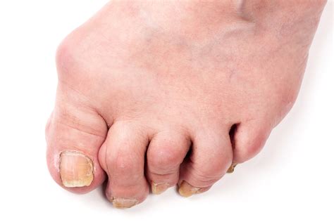 What Is Rheumatoid Arthritis In The Foot Marietta Foot Doctor