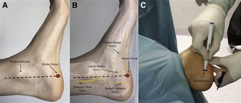 Two Portal Endoscopic Plantar Fascia Release Step By Step Surgical