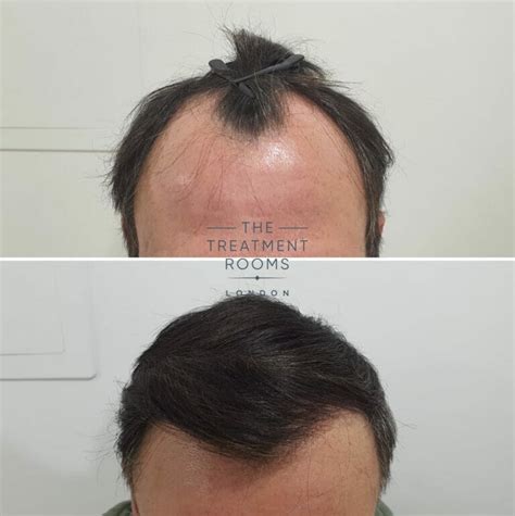 Fixing A Widows Peak With A Hair Transplant Treatment Rooms London