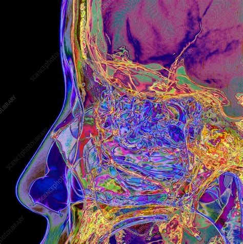 Paranasal Sinuses 3d Ct Scan Stock Image C0457095 Science Photo