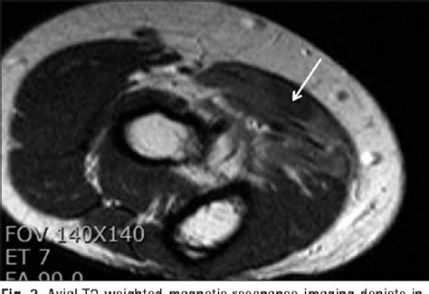 Figure 3 From Early Surgical Treatment Of Pronator Teres Syndrome