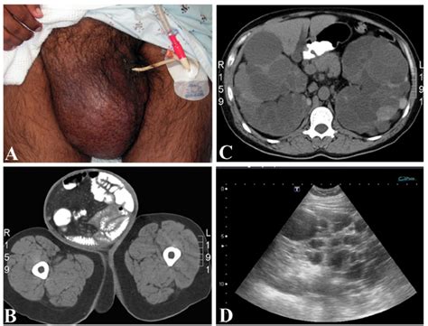 A Gross Appearance Of Inguinal Hernia B Computed Tomography