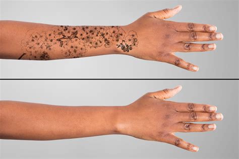 New Laser Tattoo Removal Technology Is Changing The Game Spali