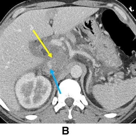 Necrotizing Pancreatitis With Acute Necrotic Collection And Secondary