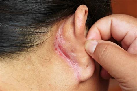 Wound Behind Ear — Stock Photo © Gap 154946682