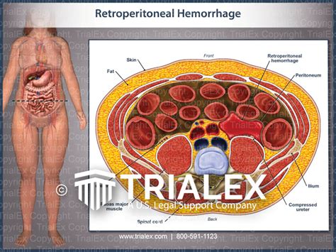 Retroperitoneal Hemorrhage Trialexhibits Inc