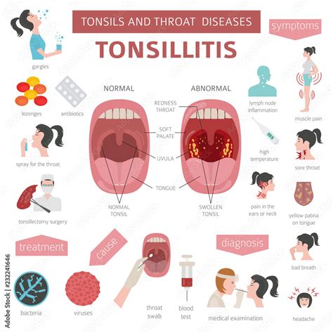 Vecteur Stock Tonsils And Throat Diseases Tonsillitis Symptoms