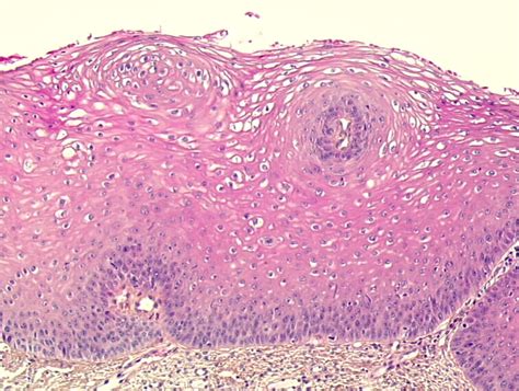 Histopathology Of The Uterine Cervix Digital Atlas