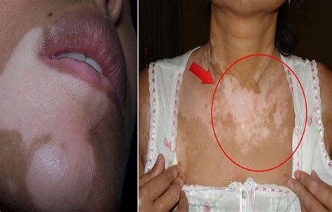 Remove The White Spots On The Skin Virgilio In Several Steps With
