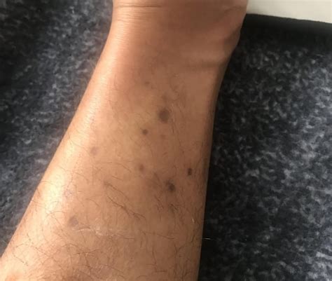 30m Brown Spots Around Ankles And Shins Its Not Itchy But Randomly